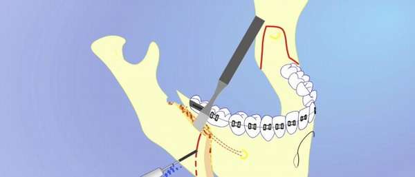 Остеотомия нижней и верхней челюсти